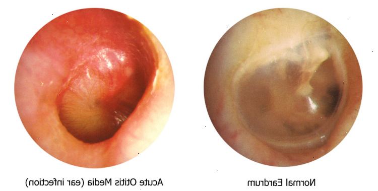 Hvad er behandlingen for en øre infektion? Antibiotika - er foreskrevet i nogle tilfælde.