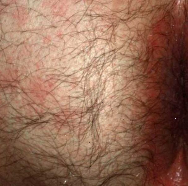 Hvad er pruritus ani? En tumor i anus eller endetarmen.
