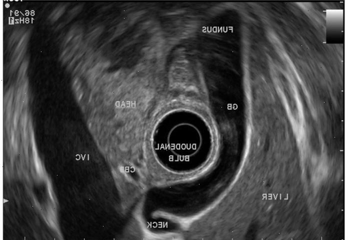 Endoskopisk ultralydsskanning. Hvad er en endoskopisk ultralydsskanning?