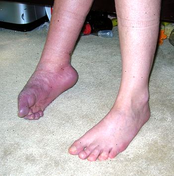 Hvad er komplekse regionale smerte syndrom? Fingernegl eller toenail ændringer.