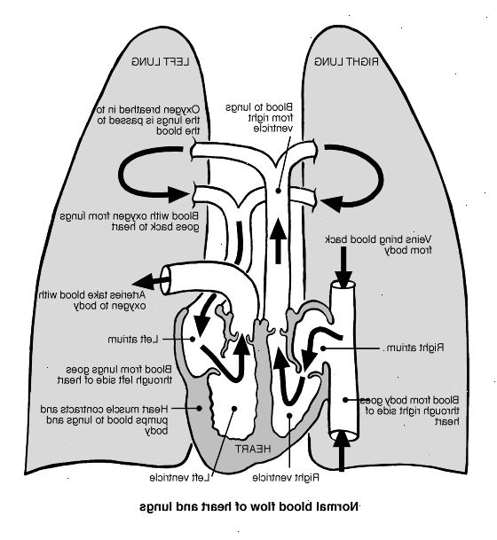 Hvad er coarctatio af aorta? Hvad der forårsager coarctatio af aorta?
