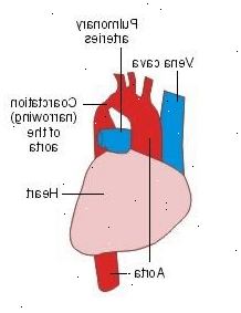 Hvor almindeligt er coarctatio af aorta? Hvad er symptomerne på coarctatio af aorta?