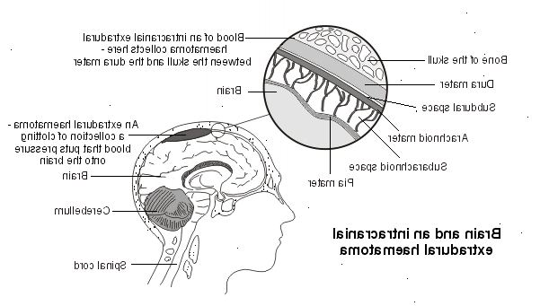 Extradural hæmatom. Hvad er hjernehinderne og epiduralrummet?