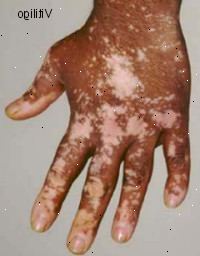 Vitiligo. Forståelse af huden.