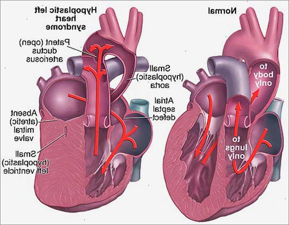 Cardiac syndrom X. Hvad er hjerte syndrom x?