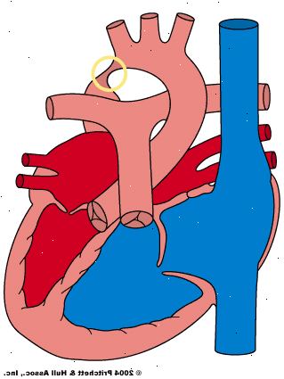 Hvordan coarctatio af aorta diagnosen? Hvad er behandlingen for coarctatio af aorta?